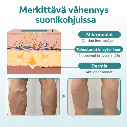 VenaLievä™ – Mikroneulalaastari raskaiden jalkojen ja suonten tueksi