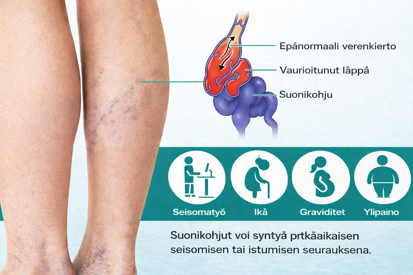 VenaLievä™ – Mikroneulalaastari raskaiden jalkojen ja suonten tueksi